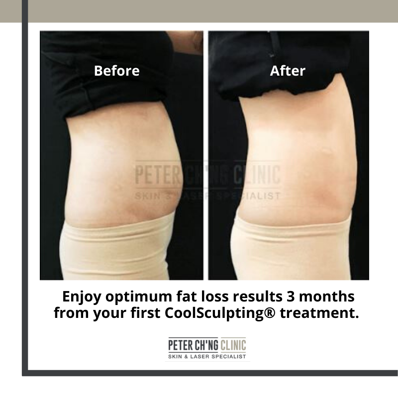 Myths And Facts About CoolSculpting Body Shaping Treatment – Dr