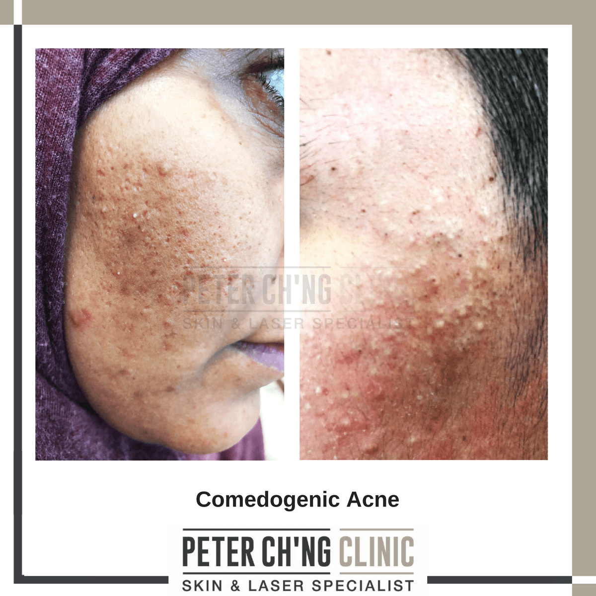 Comedogenic acne