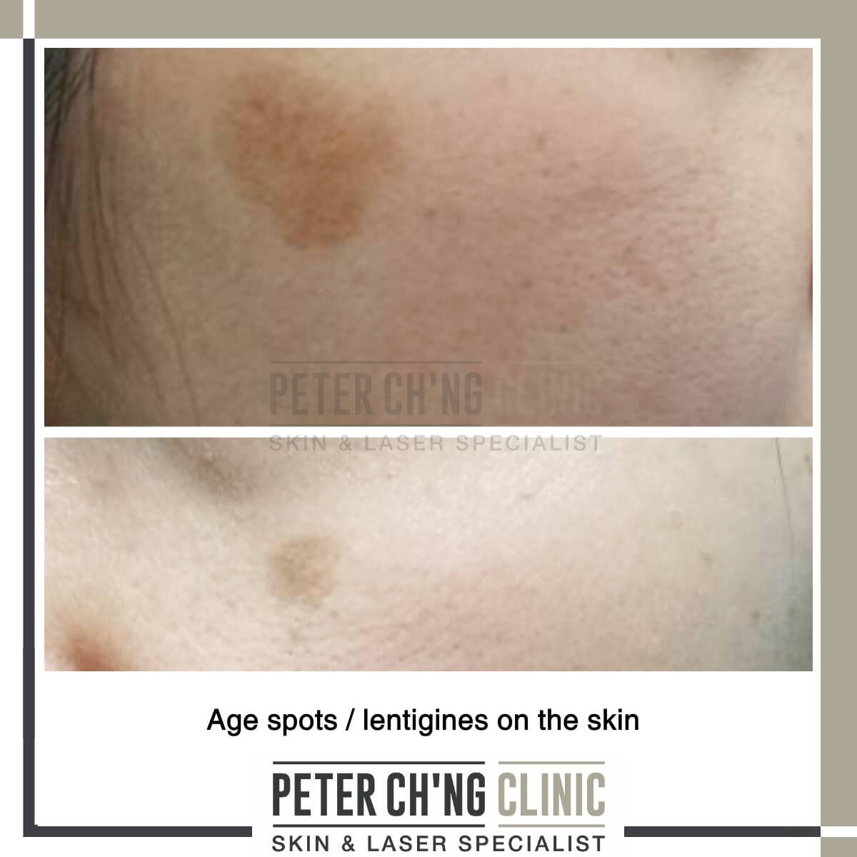 Age Spots Not Necessarily Due To Old Age Peter Ch Ng Skin Specialist Kl Malaysia