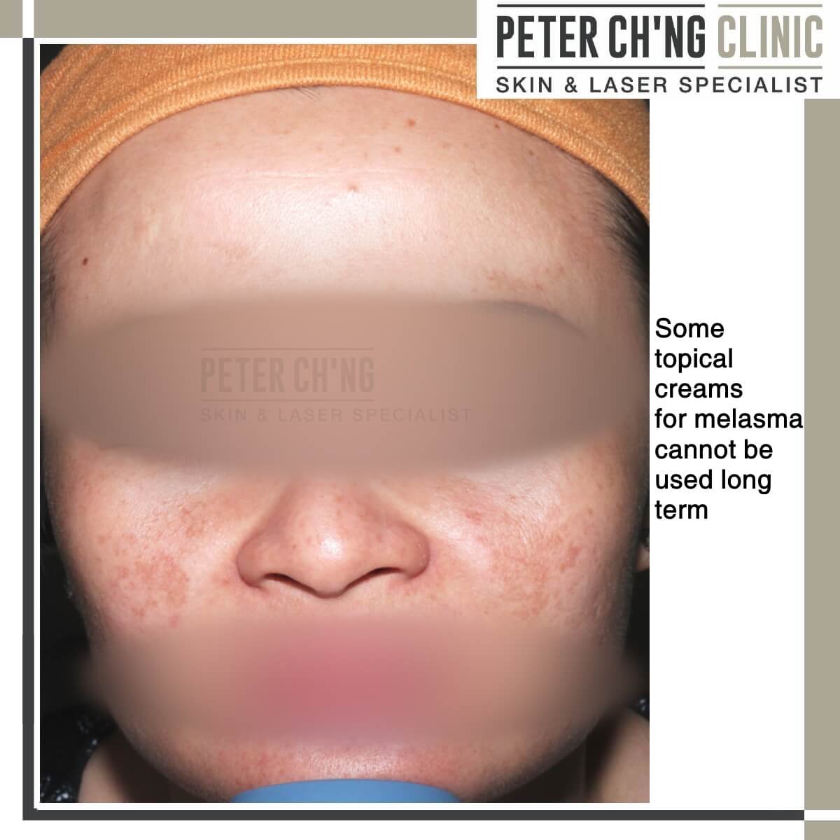 Topical cream for melasma