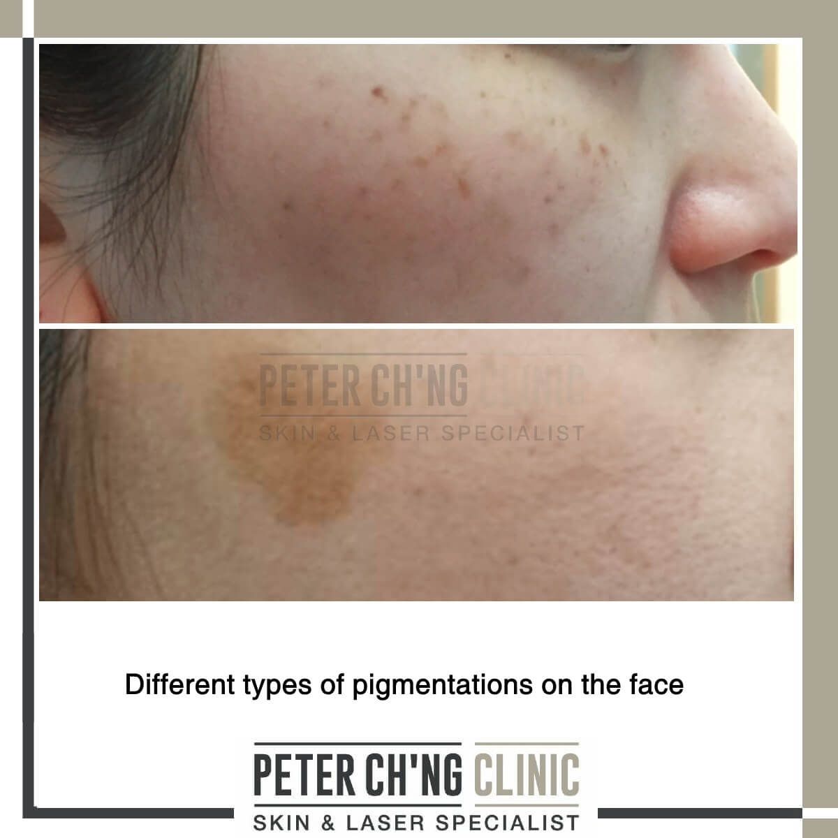 Age Spots & Pigmentation - Laser Skin Care